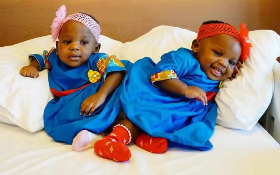 Cameroonian Conjoined Twins Get Treatment in Turkey